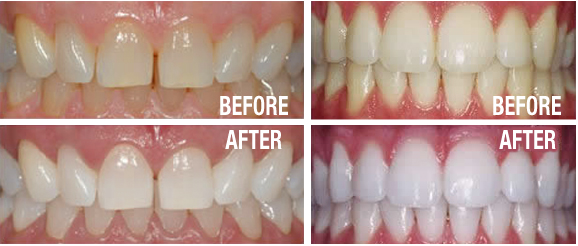 whitening teeth enamel