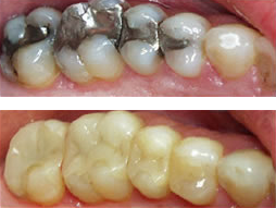 Tooth Colored Fillings  What Else Can Tooth-Colored Fillings Do?