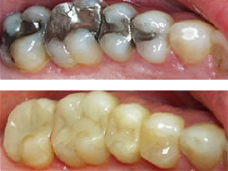 Tooth Colored Fillings