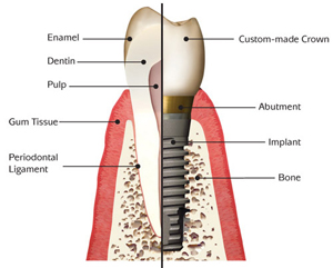 NOVA Dental  After Your Dental Implants Surgery: Caring for Your