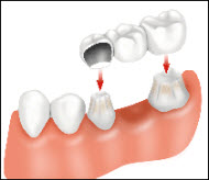 Porcelain Fixed Bridges