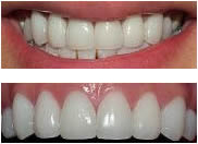 Porcelain Crowns