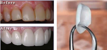 Porcelain Veneers