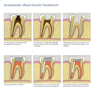 Root Canal Therapy