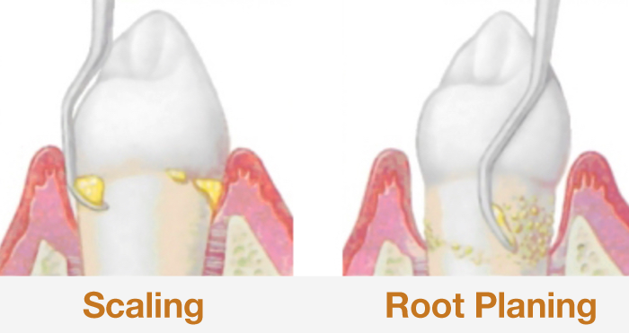 Scaling and Root Planing